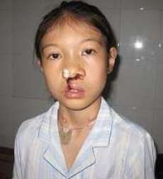 Ha Len after her lip surgery