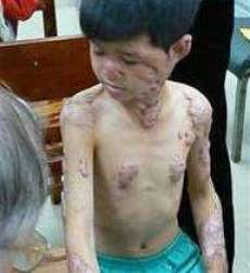 One of Project Hue’s patients, nine-year-old Manh suffered 40 per cent body burns from a fire set by his parents in a suicide attempt